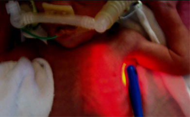 Pneumothorax illumination using Astodia